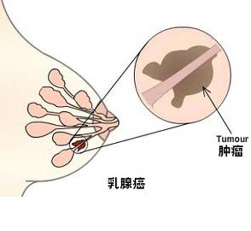 不抽烟不喝酒的大伯尽得乳腺癌