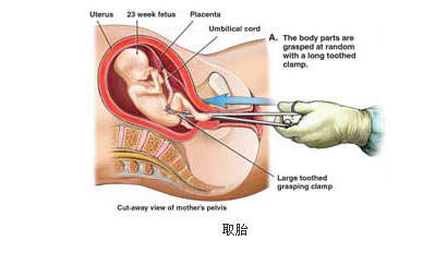 图解人流手术全过程